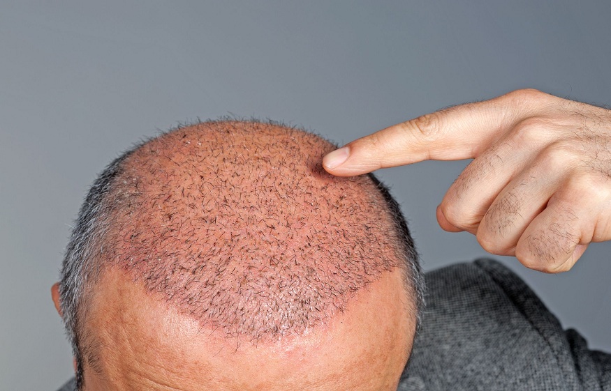 Do hair transplants work?