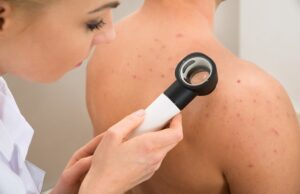 neurofibromatosis